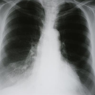 Cover image for research topic "Insights in Thoracic Oncology: 2021/2022"