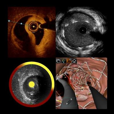 Cover image for research topic "Intracoronary Imaging Guidance for Percutaneous Coronary Interventions"