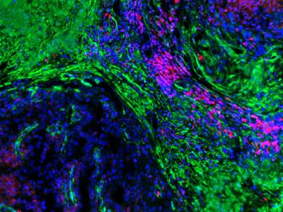 Cover image for research topic "New Insights into Fibrotic Signaling in Cancer"