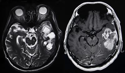 Cover image for research topic "Rising stars in Neuro-Oncology and Neurosurgical Oncology 2021"