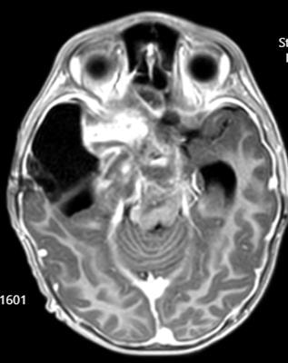 Cover image for research topic "Optic Pathway Glioma: A multidisciplinary entity, posing dilemmas in diagnosis and management"