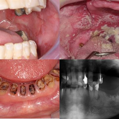 Cover image for research topic "Oral Complications in Cancer Patients"