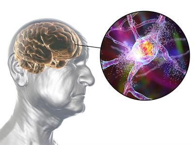 Cover image for research topic "Neurodegeneration: From Disease Mechanism to Therapeutic Advancement"