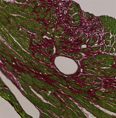 Cover image for research topic "Cardiac Fibrosis in Heart Failure: Understanding the pathogenic mechanisms to develop therapeutic opportunities"