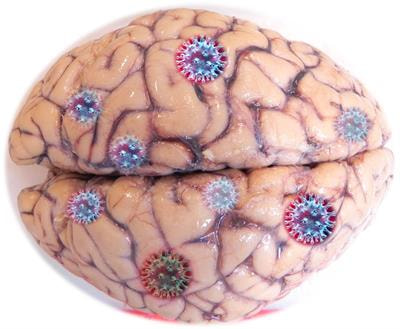 Cover image for research topic "An Update on Neurological Disorders Post COVID-19  Infection"