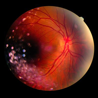 Cover image for research topic "Insights in Inflammatory Eye Diseases: 2021"