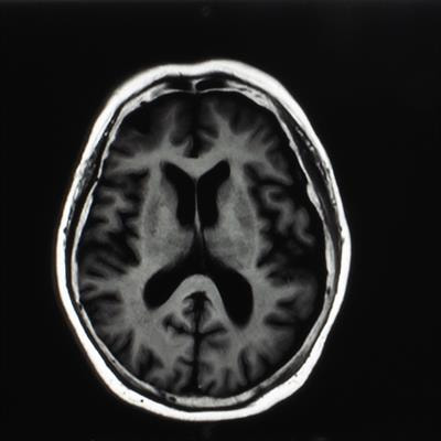 Cover image for research topic "Decompressive Craniectomy and Cranioplasty: Challenges and chances"