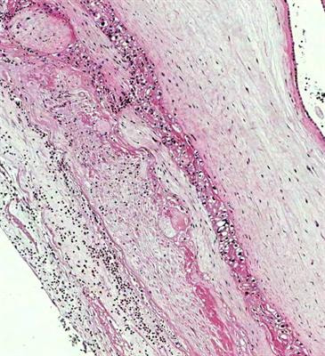 Cover image for research topic "Advances in the prevention and treatment of inflammation-associated preterm birth"