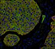 Cover image for research topic "Epithelial mesenchymal interactions and transitions during carcinoma progression"