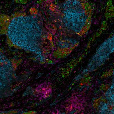 Cover image for research topic "Accelerating Cancer Biology through Spatial-Omics Approaches"