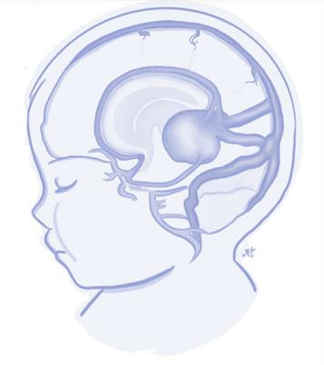 Cover image for research topic "Vein of Galen Aneurysmal Malformation: a Scientific and Clinical Journey Targeting the Best Outcome"