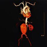 Cover image for research topic "Abdominal Aortic Aneurysms: Advancements in diagnosis, biomarkers, drug therapeutics, surgical and endovascular treatment"