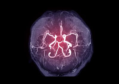 Cover image for research topic "Editors' Showcase: Acute Stroke and Interventional Therapies"