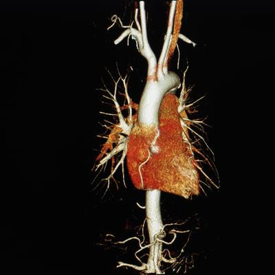 Cover image for research topic "Multimodality Imaging in the Assessment of Ischemic Chronic Coronary Syndrome"