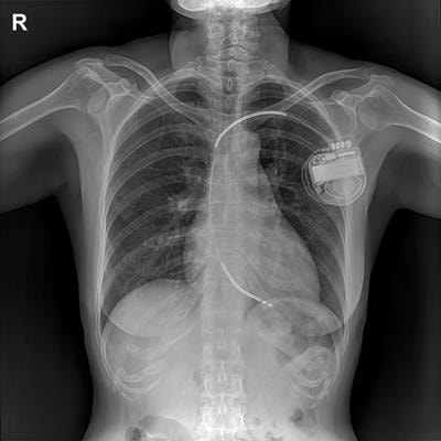 Cover image for research topic "Management of Right Ventricular Failure: Pathophysiology, medical treatment and use of ventricular assist devices"