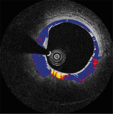 Cover image for research topic "Translational Clinical Intraluminal Imaging and Optical Sensing"