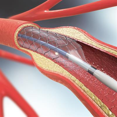 Cover image for research topic "Precision Medicine for Antithrombotic Therapy in Patients after Percutaneous Coronary Interventions"