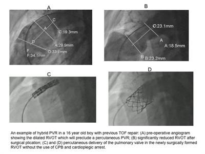 Cover image for research topic "The developments of hybrid surgical strategies for congenital heart disease"
