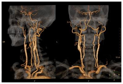 Cover image for research topic "Chronic Carotid Artery Occlusion: Surgical Techniques, Screening modalities, Evaluation Scale, Prescription, and Beyond"