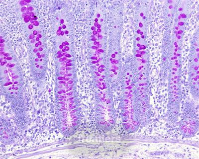 Cover image for research topic "Computational Pathology for Precision Diagnosis, Treatment, and Prognosis of Cancer"