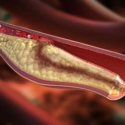 Cover image for research topic "Primary Percutaneous Coronary Intervention for Acute Coronary Syndrome: Innovations towards a tailored approach"
