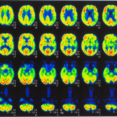 Cover image for research topic "Reviews in: Radiopharmaceuticals in Nuclear Medicine"