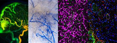 Cover image for research topic "Cerebral and Spinal Vascular Malformations: From Bench to Bedside"