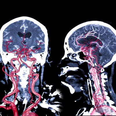 Cover image for research topic "Therapeutic strategies for acute aneurysmal subarachnoid hemorrhage – clipping or coiling, that is the question!"