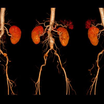 Cover image for research topic "Advanced Research on Abdominal and Thoracic Aortic Aneurysms: New insights into molecular mechanisms"