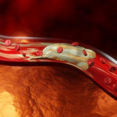 Cover image for research topic "Emerging Therapeutics for Peripheral Artery Disease"