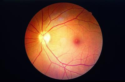 Cover image for research topic "Identification of Novel Biomarkers for Retinopathy of Prematurity in Preterm Infants by use of Innovative Technologies and Artificial Intelligence"