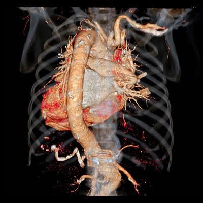 Cover image for research topic "Infiltrative Cardiomyopathy and Heart Failure"