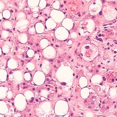 Cover image for research topic "Liver Diseases and Programmed Cell Death"