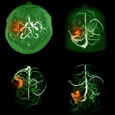 Cover image for research topic "Pushing the Frontiers of Stroke Care and Research - Where are We Heading?"