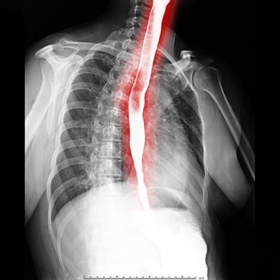 Cover image for research topic "Malnutrition in Dysphagia: Nutritional Assessment and Management in Clinical Practice"