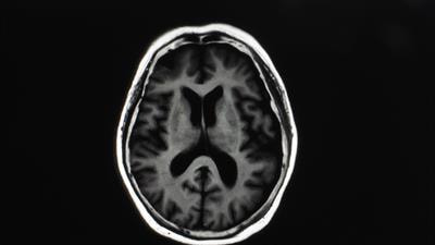 Cover image for research topic "Neurovascular Dysfunction After Brain Injury"