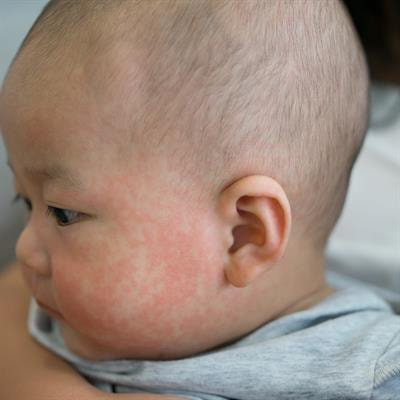 Cover image for research topic "The Expanding Role of Human Microbiome in Pediatric Allergic Diseases"