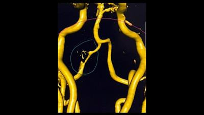 Cover image for research topic "Stroke and Balance Disorders"
