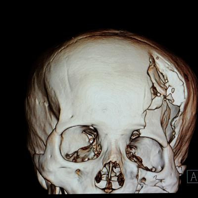 Cover image for research topic "Stem Cells in Craniofacial Development and Deformity Regeneration"