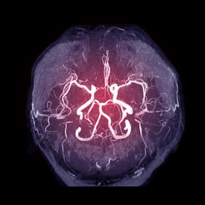Cover image for research topic "Moyamoya disease – natural history and therapeutic challenges"