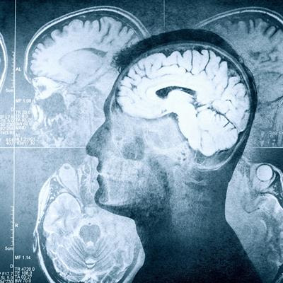 Cover image for research topic "Investigating Brain Activity After Acquired and Traumatic Brain Injury: Applications of Functional MRI"
