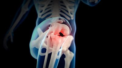 Cover image for research topic "Multi-Modal Approaches to Assess the Impact of Orthopaedic Disease on Lower Extremity Joint Function and Health"