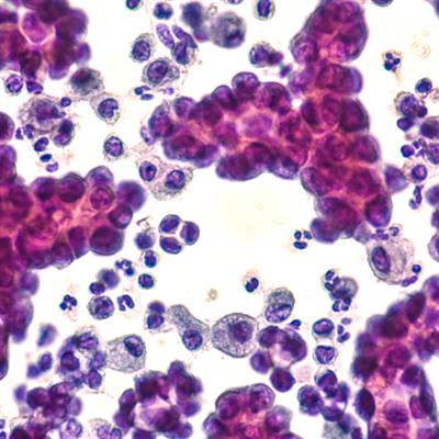 Cover image for research topic "Cuproptosis and Tumor"