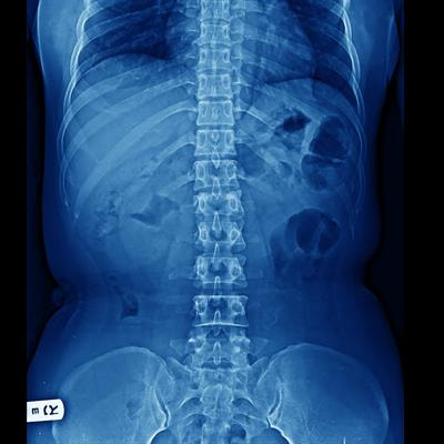 Cover image for research topic "Surgical Treatment Of Spinal Infections: Management of Spondylodiscitis and Implant-Associated Vertebral Osteomyelitis"