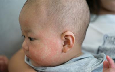 Cover image for research topic "Allergic Diseases and Microecology"