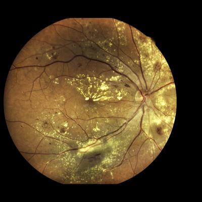 Cover image for research topic "X-Linked Retinoschisis: Mechanisms and Therapies"