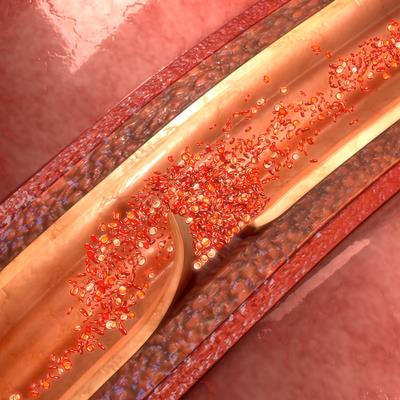 Cover image for research topic "Spontaneous Coronary Artery Dissection: Current State of Diagnosis and Treatment"