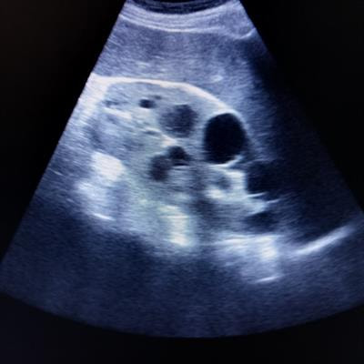 Cover image for research topic "Cystic Kidney Diseases in Children and Adults: From Diagnosis to Etiology and Back"