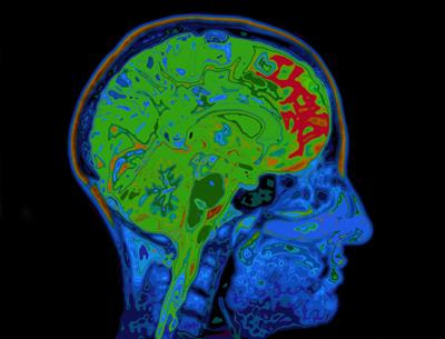 Cover image for research topic "Neural correlates of connected speech indices in acquired neurological disorders."