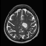 Cover image for research topic "Advances of Brain Metastasis in Breast Cancer"